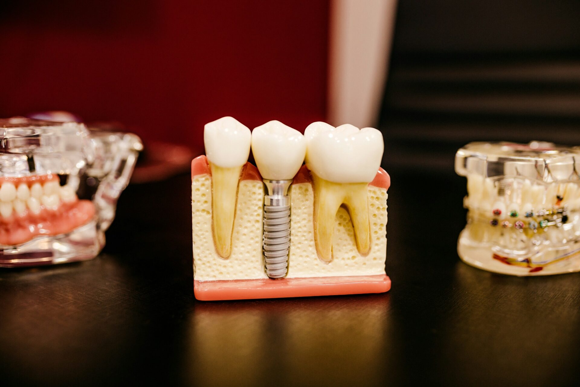 Implantology and How To Specialise